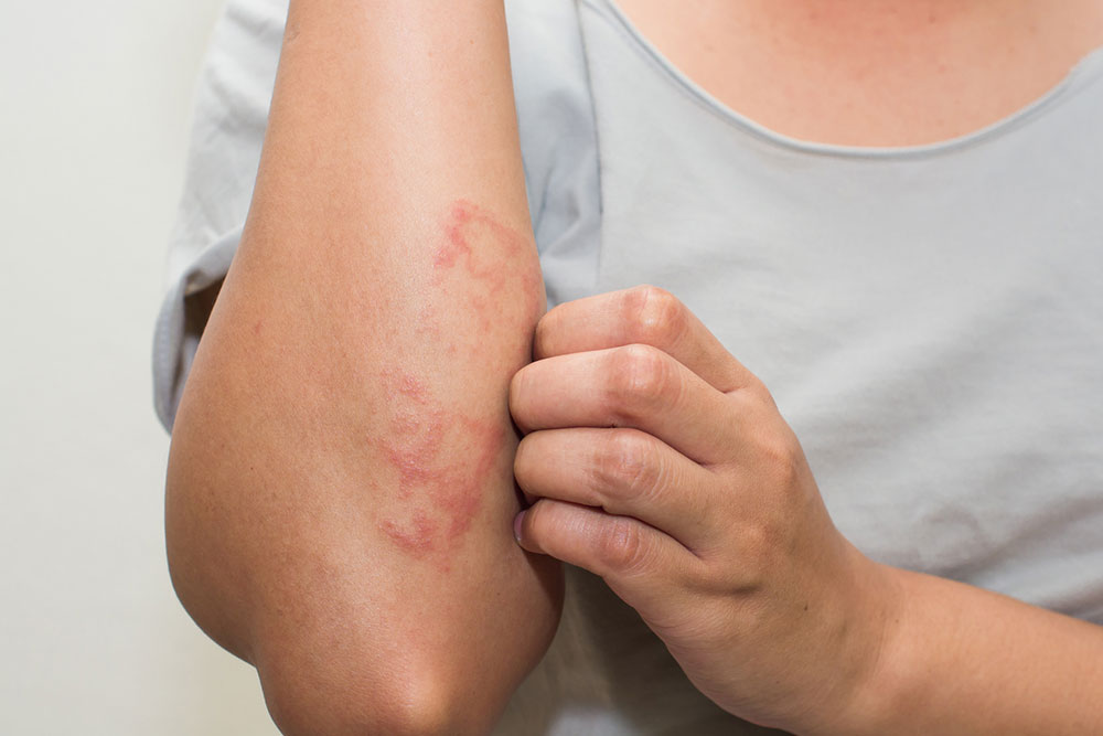 Common Types and Treatments of Eczematous Dermatitis
